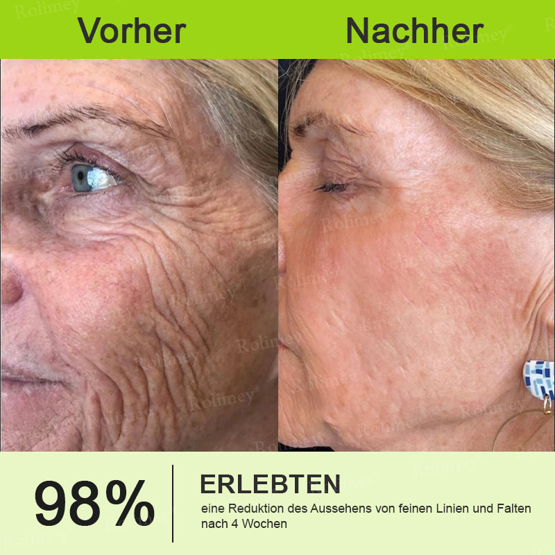 🍀👑✨Jetzt jugendliche Haut zurückgewinnen 💫Rolimey® Botox & Vita-A Retinol Shot Falten-Lift Straffungscreme