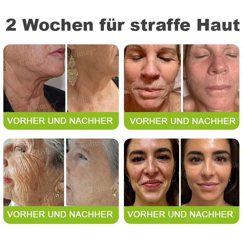🍀👑✨Jetzt jugendliche Haut zurückgewinnen 💫Rolimey® Botox & Vita-A Retinol Shot Falten-Lift Straffungscreme